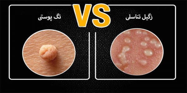  آیا منگوله پوستی / اسکین تگ خطرناک است؟