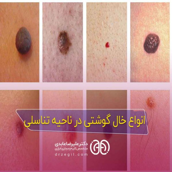  اسکین تگ ناحیه تناسلی زنان