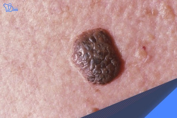  اسکین تگ ناحیه تناسلی زنان