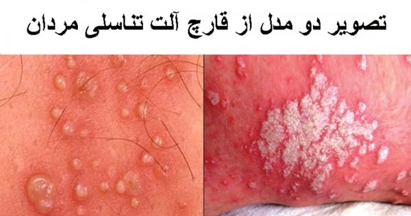 عکس قارچ دستگاه تناسلی مردان + عکس قارچ دستگاه تناسلی زنان