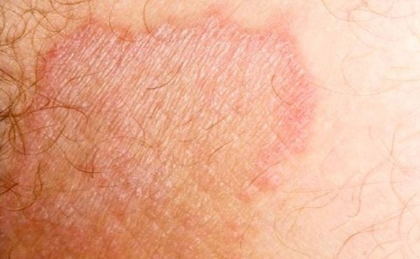  عکس قارچ دستگاه تناسلی مردان + عکس قارچ دستگاه تناسلی زنان