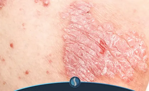  عکس قارچ دستگاه تناسلی مردان + عکس قارچ دستگاه تناسلی زنان