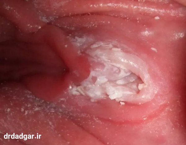  عکس قارچ دستگاه تناسلی مردان + عکس قارچ دستگاه تناسلی زنان