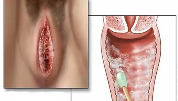  عکس قارچ دستگاه تناسلی مردان + عکس قارچ دستگاه تناسلی زنان