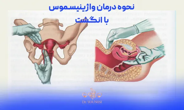  علت بسته شدن واژن هنگام دخول / دخول غیر ممکن / واژینیسموس