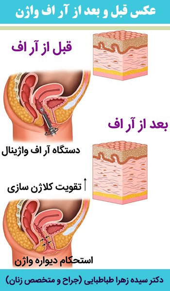  فیلم درمان واژینیسموس با آر اف