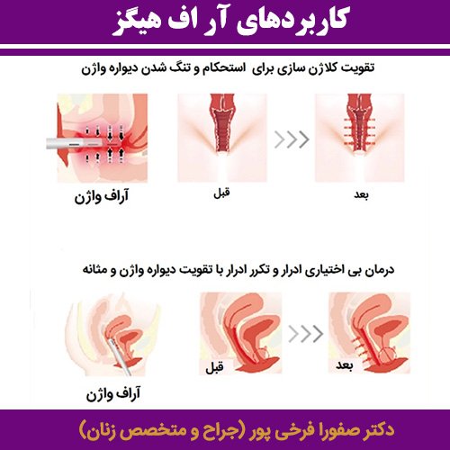  فیلم درمان واژینیسموس با آر اف