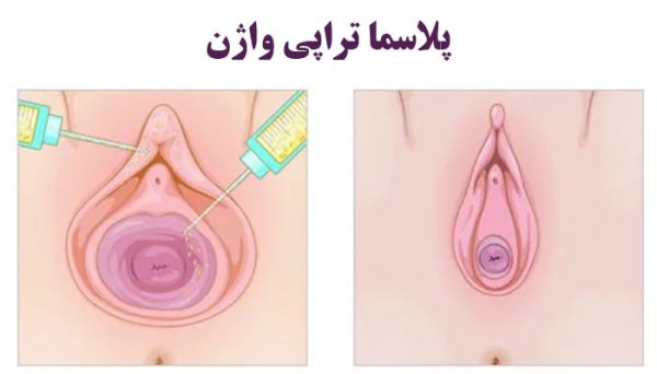 پلاسما تراپی واژن چگونه انجام میشود؟