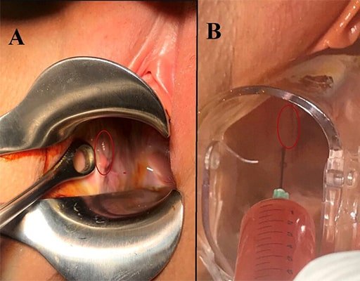  پلاسما تراپی واژن چگونه انجام میشود؟