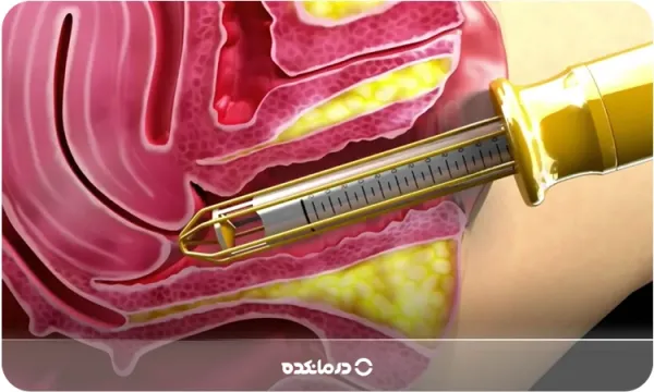  پلاسما تراپی واژن چگونه انجام میشود؟