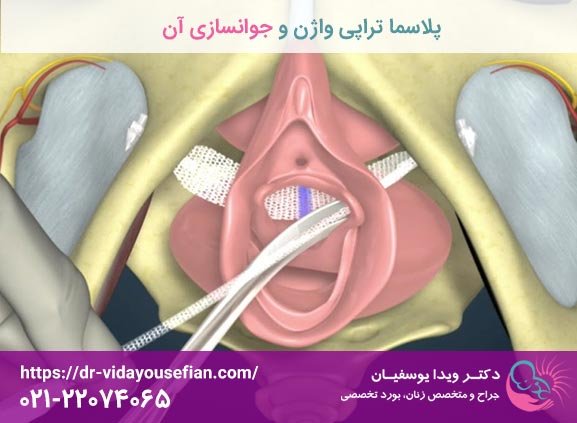  پلاسما تراپی واژن چگونه انجام میشود؟