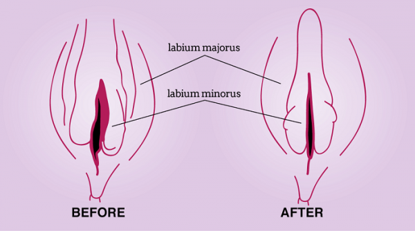  پلاسما تراپی واژن چگونه انجام میشود؟