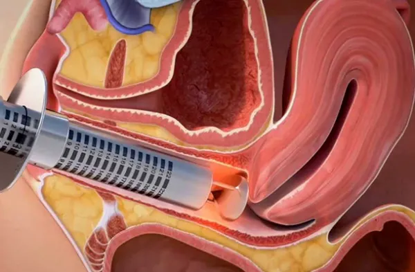  پلاسما تراپی واژن چگونه انجام میشود؟