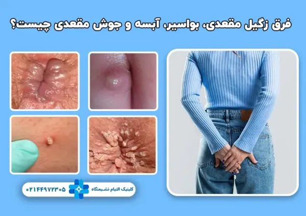  آیا زگیل مقعدی واگیردار است؟