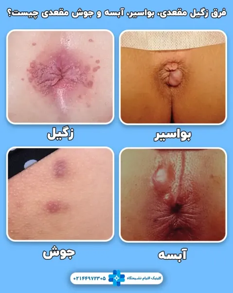  آیا زگیل مقعدی واگیردار است؟