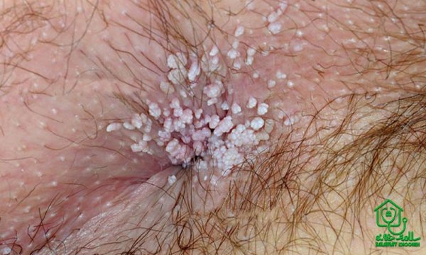  آیا زگیل مقعدی واگیردار است؟