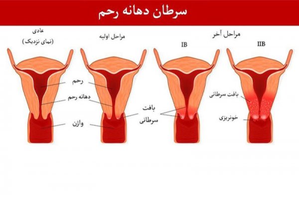  چقدر طول میکشد زگیل تناسلی تبدیل به سرطان شود؟