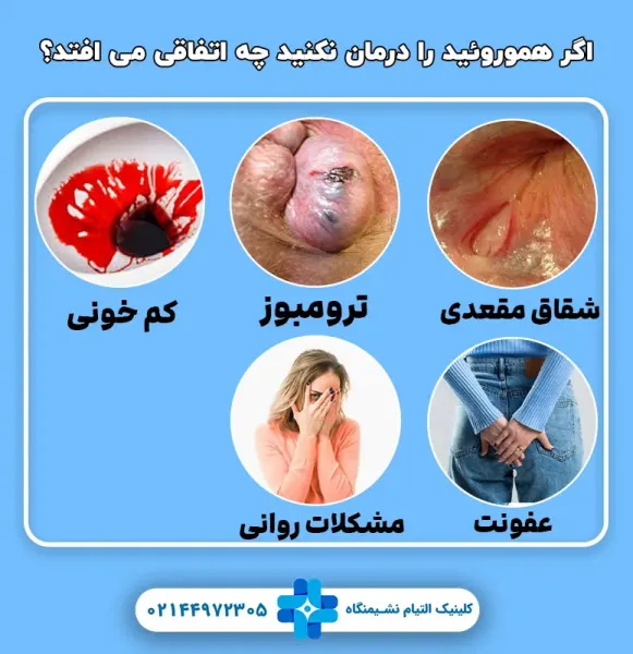  بواسیر چیست با عکس