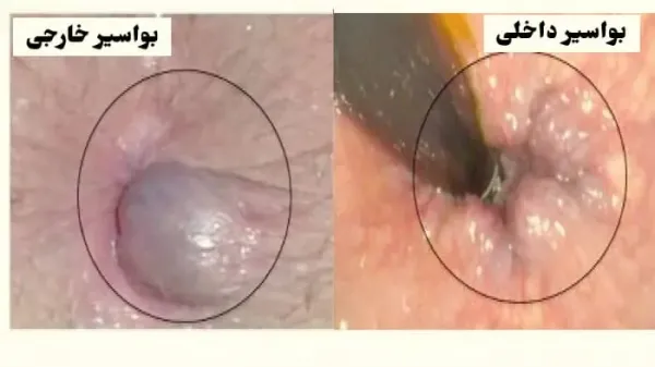  بواسیر چیست با عکس