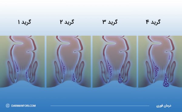  بواسیر چیست با عکس