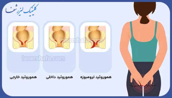  بواسیر چیست با عکس