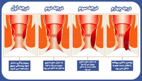  بواسیر چیست با عکس