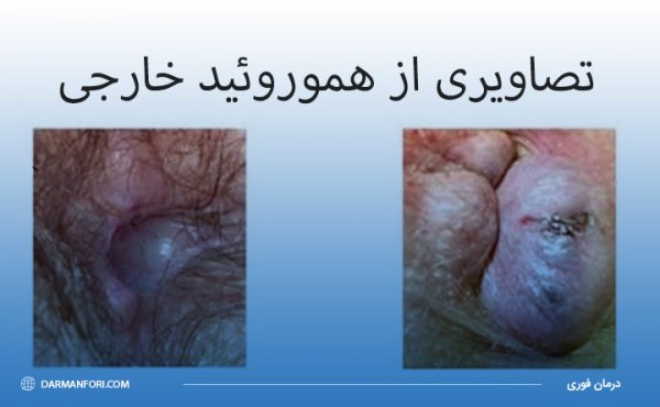  چه زمانی بواسیر خطرناک است؟