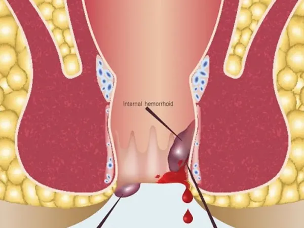  چه زمانی بواسیر خطرناک است؟