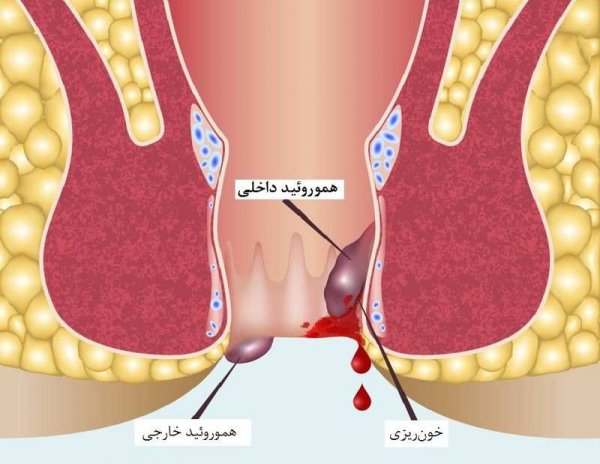 چه زمانی بواسیر خطرناک است؟