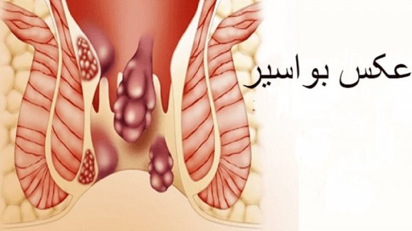  چه زمانی بواسیر خطرناک است؟