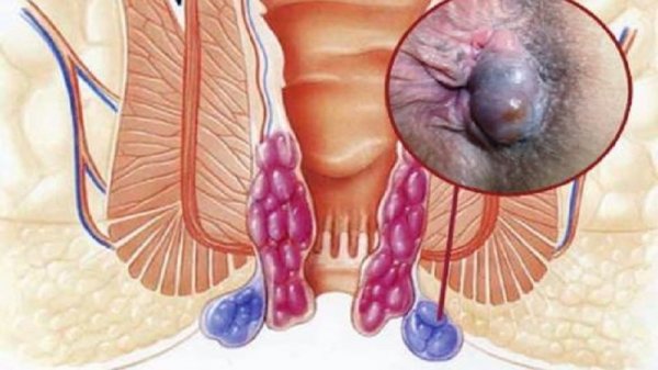  بواسیر خارجی خطرناک است یا داخلی + عکس
