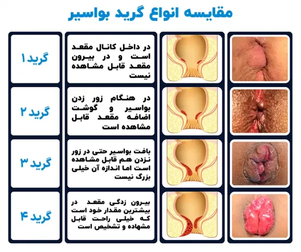  بواسیر خارجی خطرناک است یا داخلی + عکس