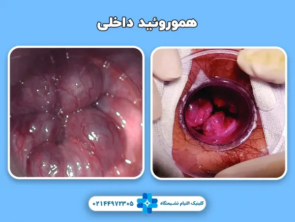  بواسیر خارجی خطرناک است یا داخلی + عکس