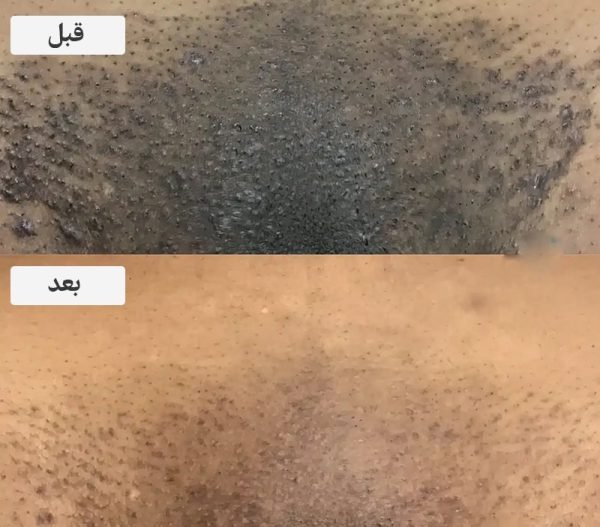  ناحیه تناسلی زنان چرا سیاه میشود؟