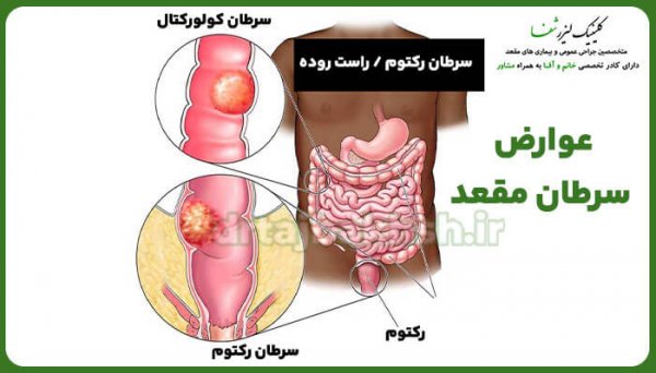  عکس سرطان مقعد + علت سرطان مقعدی چیست؟