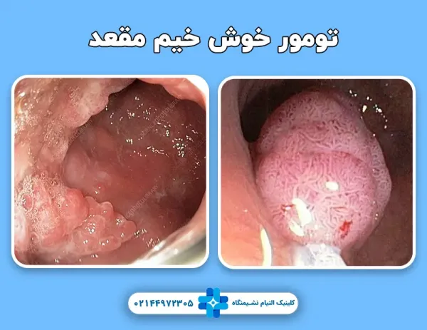  عکس سرطان مقعد + علت سرطان مقعدی چیست؟