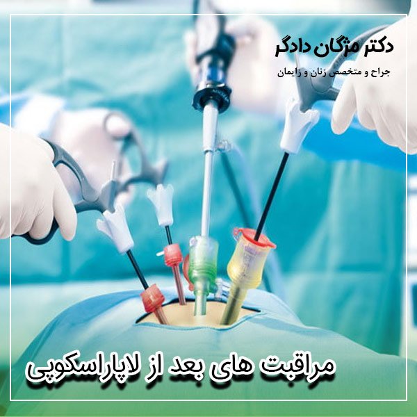 مدت زمان استراحت بعد از عمل لاپاراسکوپی رحم