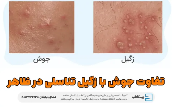  فرق زگیل مقعدی با جوش