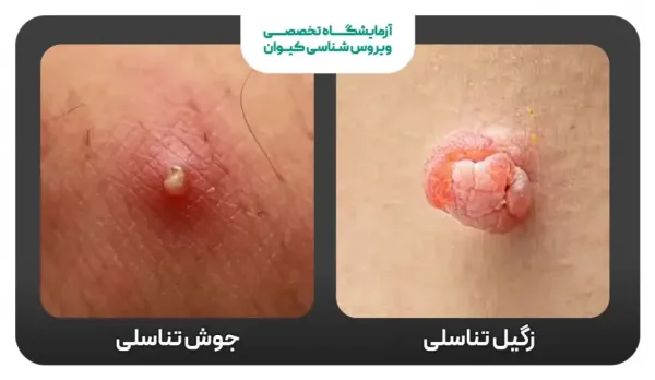  فرق زگیل مقعدی با جوش