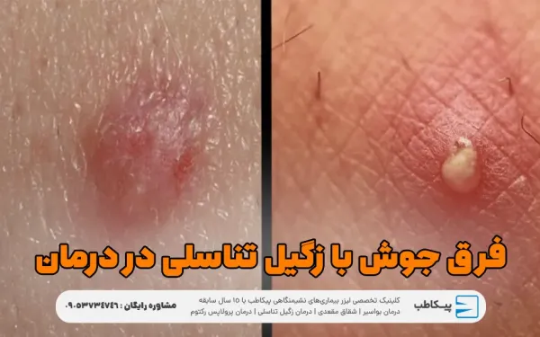  فرق زگیل مقعدی با جوش