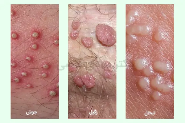  فرق زگیل مقعدی با جوش