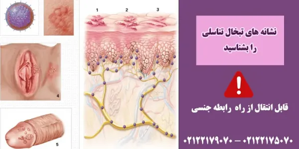  انواع تبخال تناسلی زنان