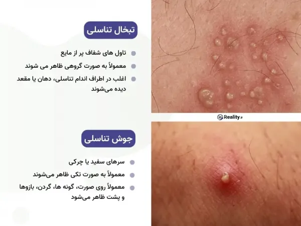  انواع تبخال تناسلی زنان