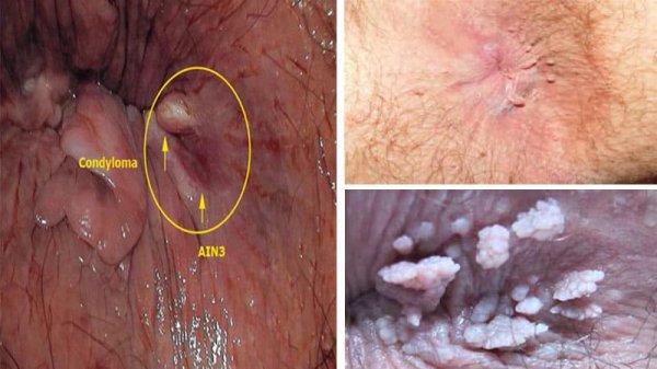  زگیل مقعدی چگونه به وجود میاد/ می آید؟