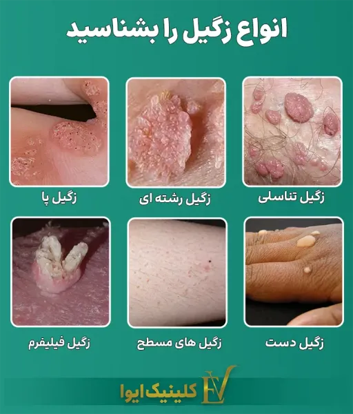  زگیل مقعدی چگونه به وجود میاد/ می آید؟