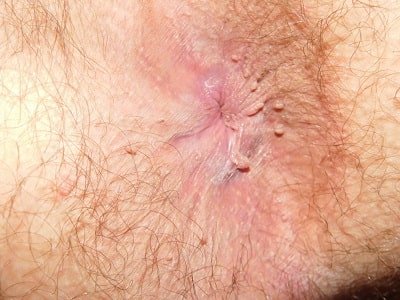  زگیل مقعدی چگونه به وجود میاد/ می آید؟