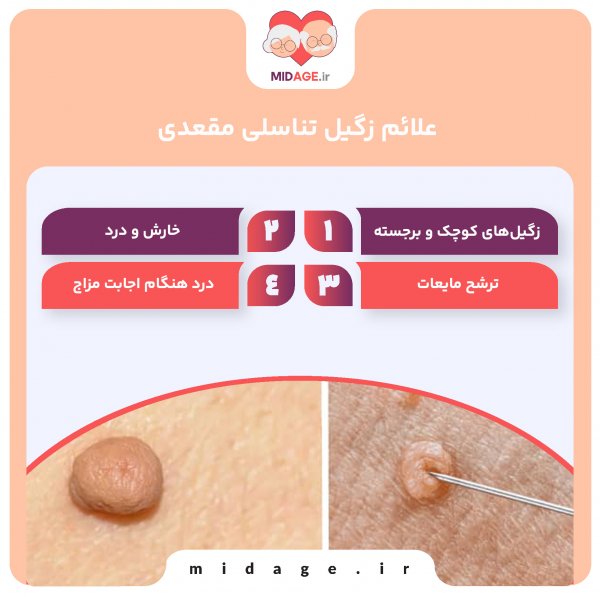  زگیل مقعدی چگونه به وجود میاد/ می آید؟