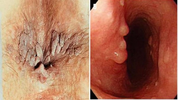  زگیل مقعدی چگونه به وجود میاد/ می آید؟