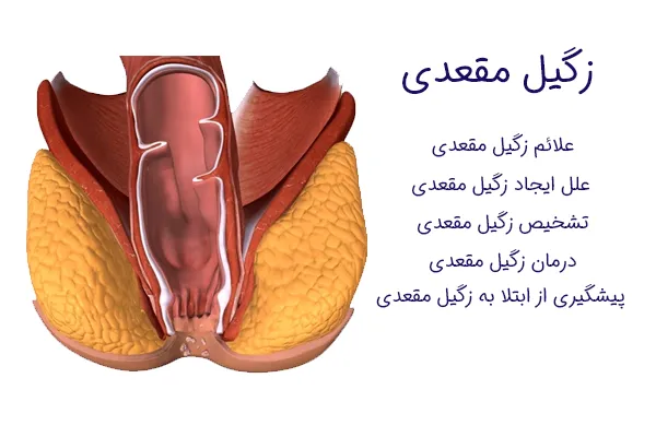 چگونه زگیل مقعدی میگیریم + چرا زگیل مقعدی میگیریم؟