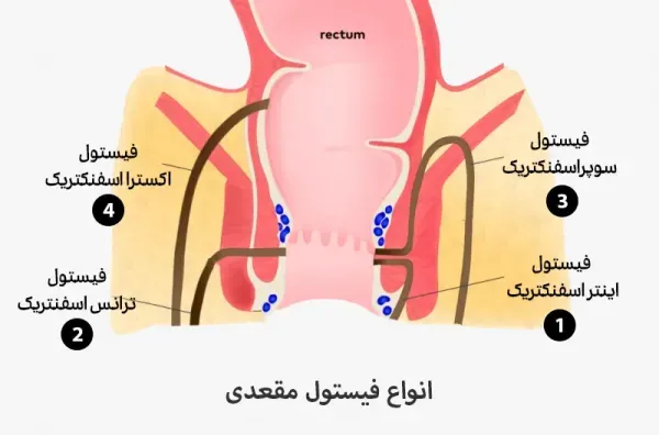  عکس عفونت مقعدی